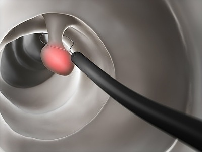 日帰り大腸ポリープ切除｜さきたに内科・内視鏡クリニック